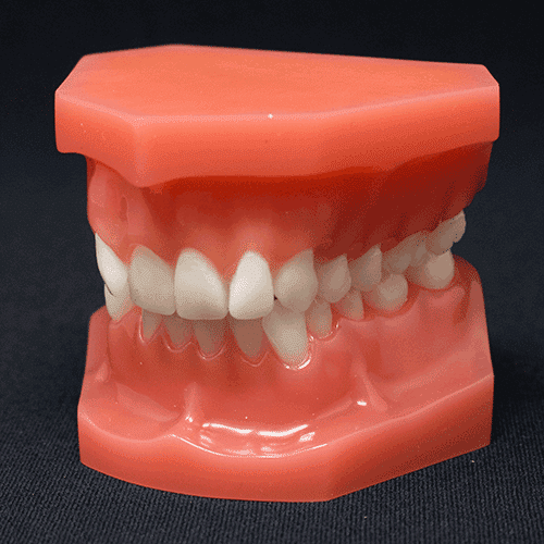 Orthodontic Typodont Class 2 Division 2 Permanent Dentition