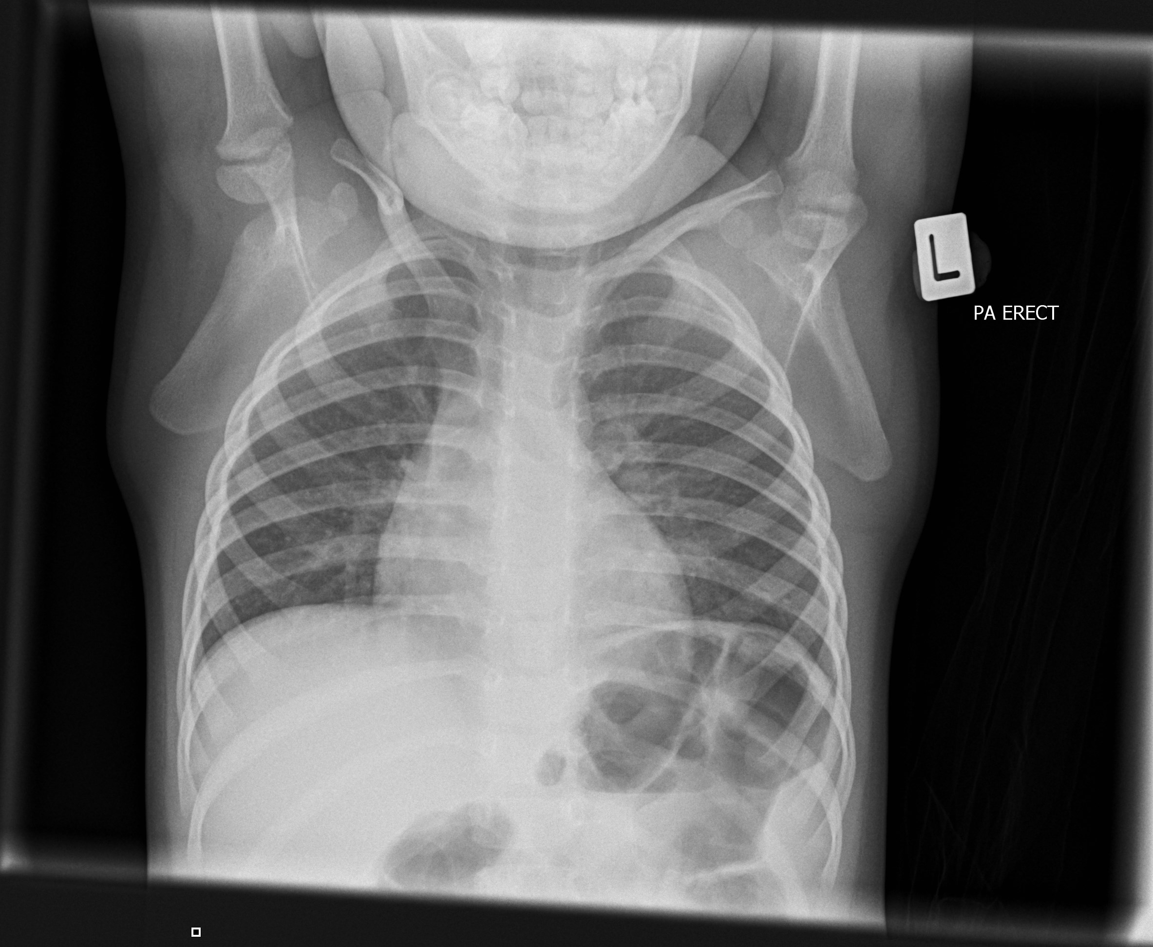 NORMAL PEDIATRIC BONE XRAYS