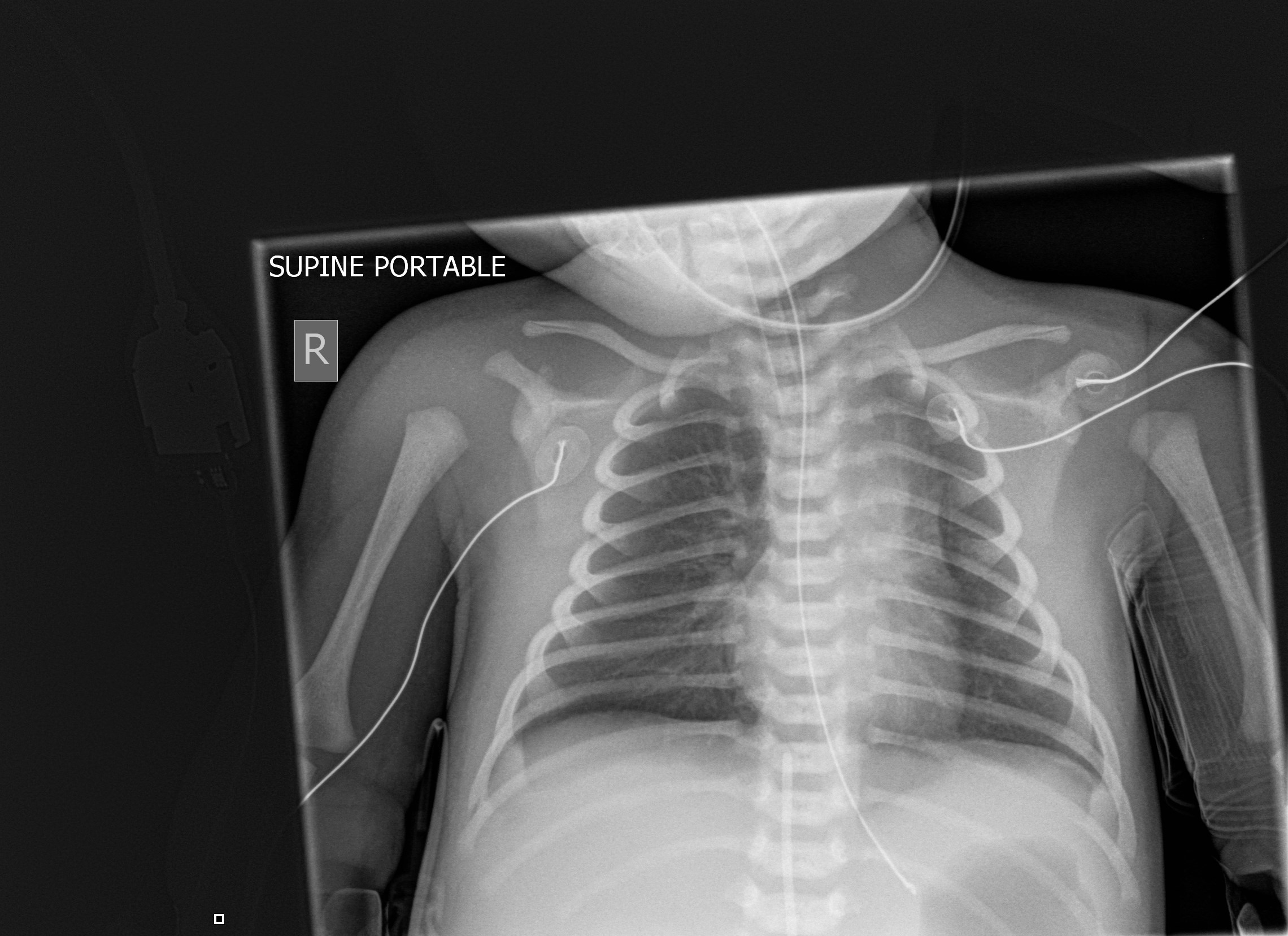 Normal Child Chest X Ray