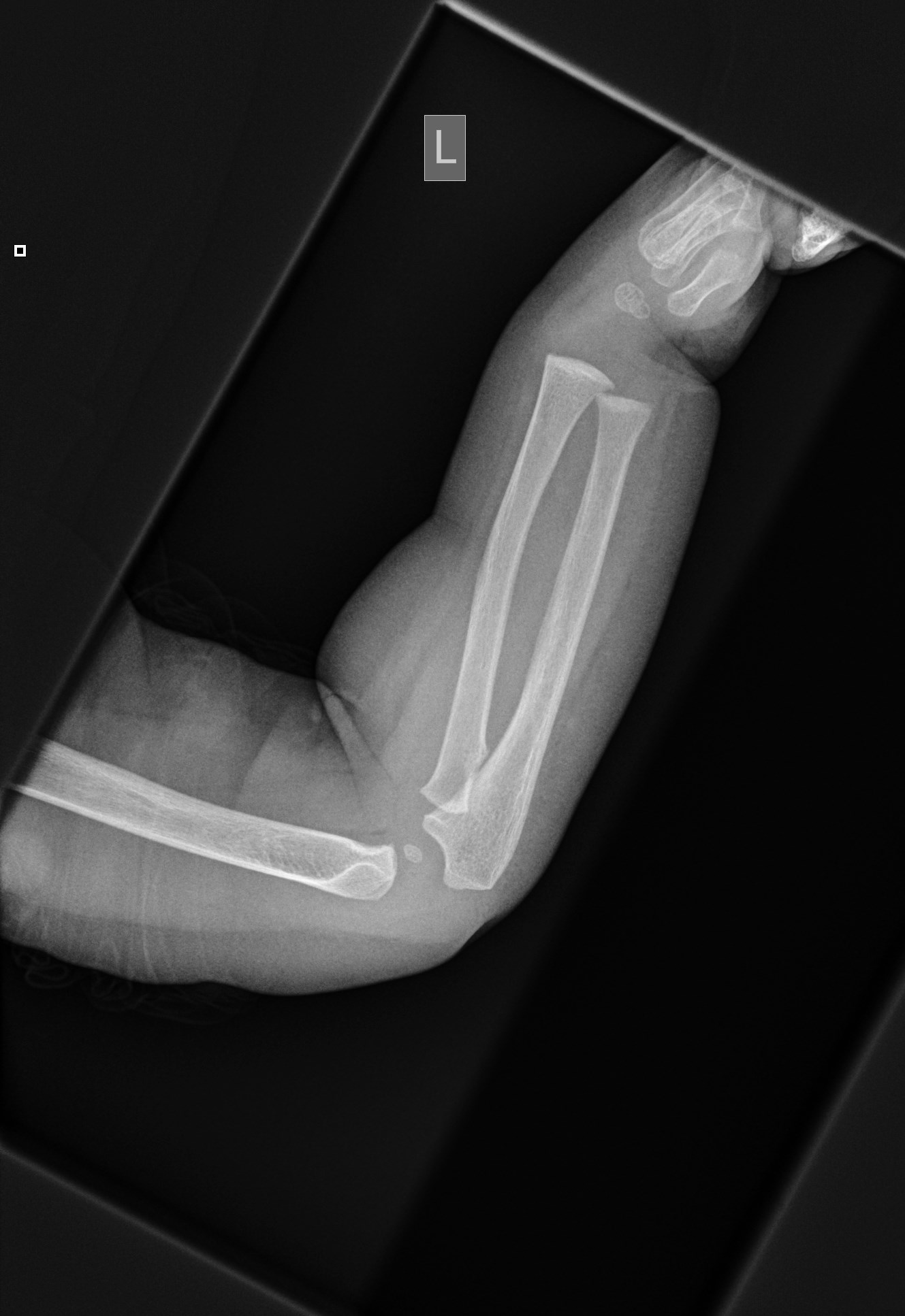 NORMAL PEDIATRIC BONE XRAYS