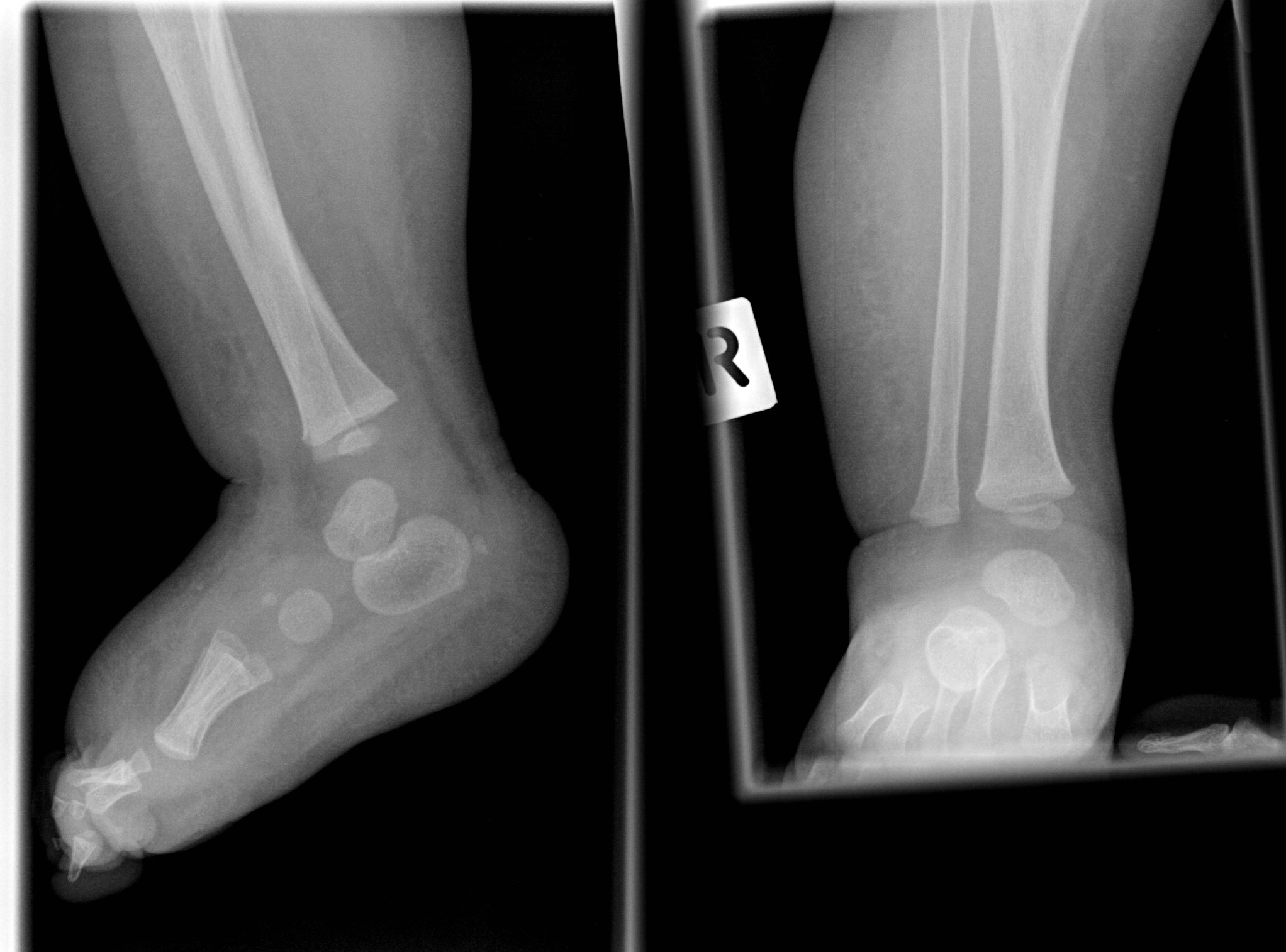 NORMAL PEDIATRIC BONE XRAYS