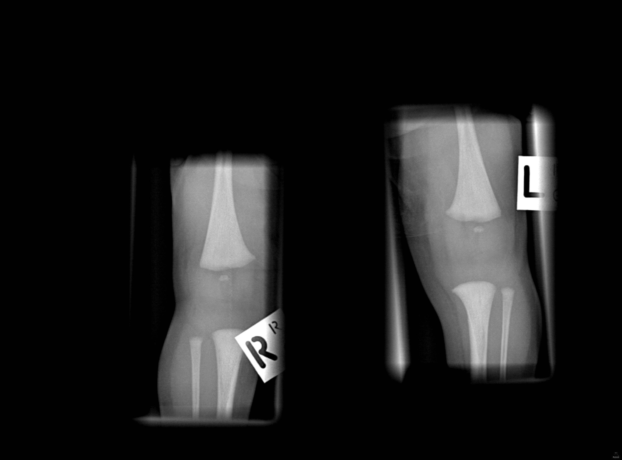 NORMAL PEDIATRIC BONE XRAYS