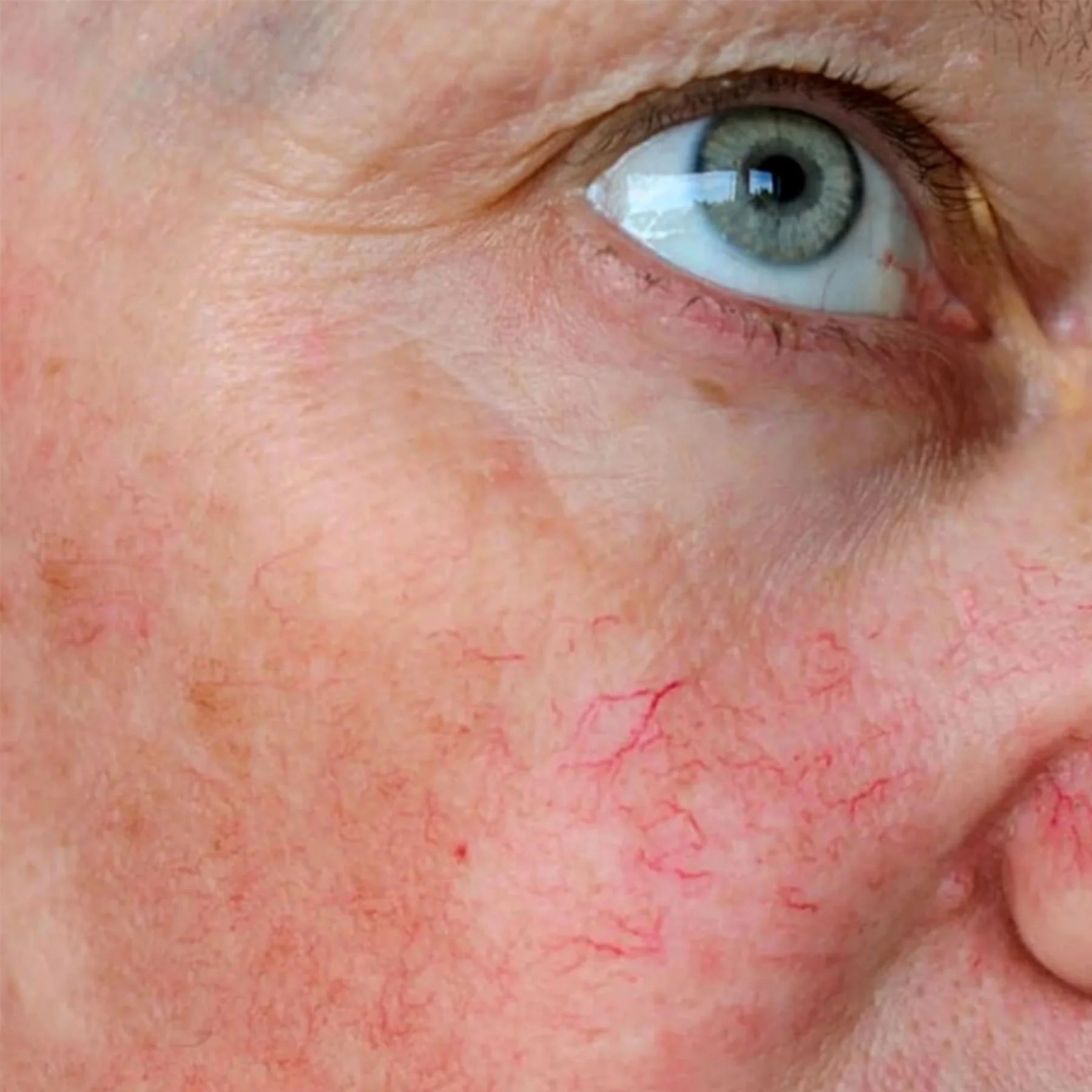 Does Red Light Therapy Help Broken Capillaries? Bontanny