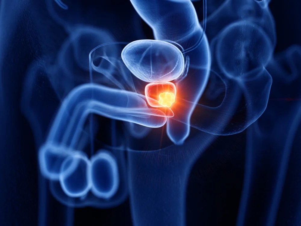 11 Prostate Cancer Treatment Options + 12 Survival Tips