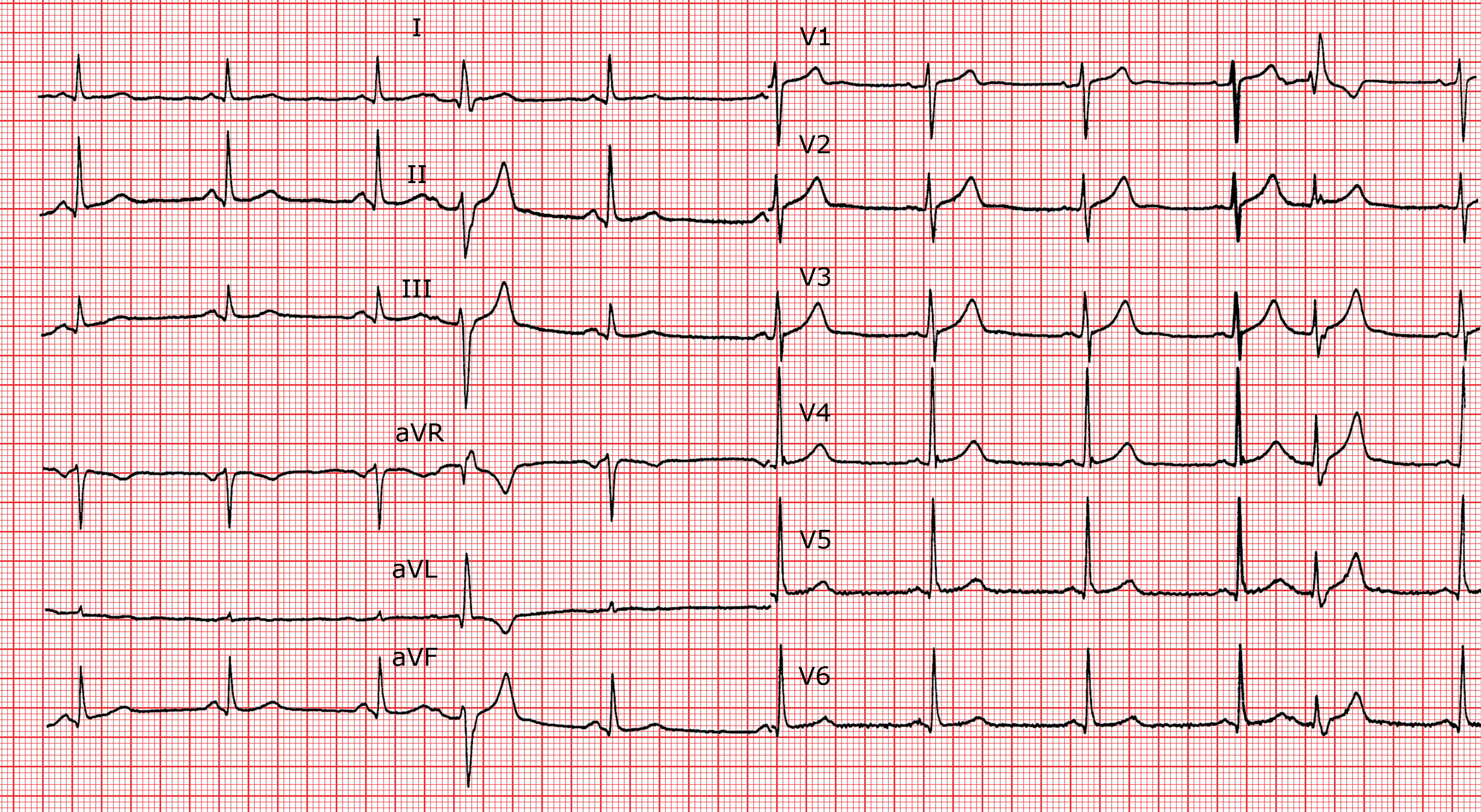 extrasystoles avant les regles