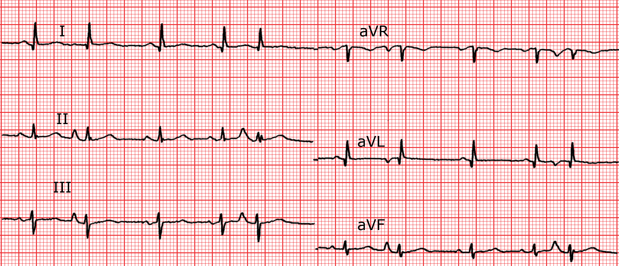 Les extrasystoles ECG