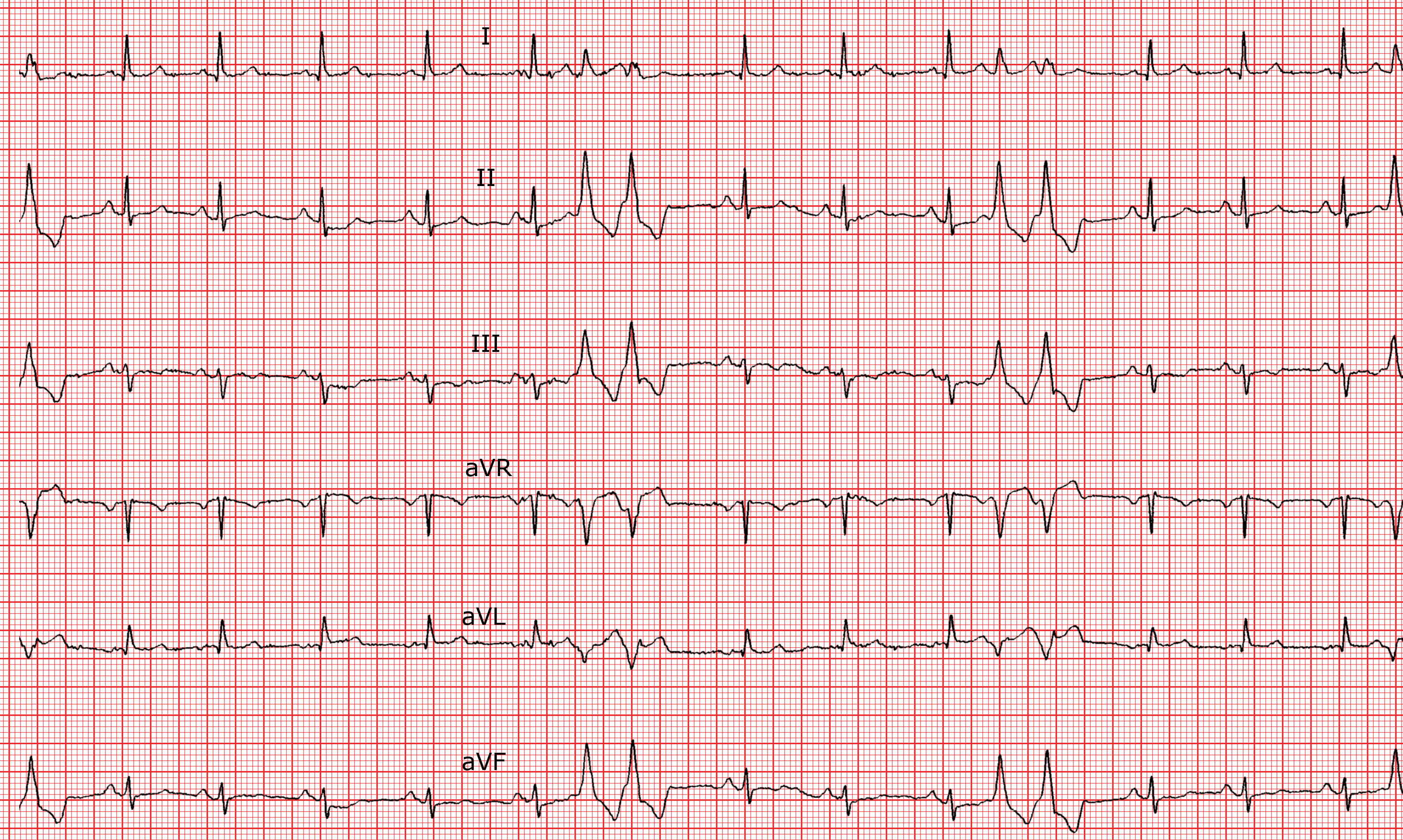 Die Extrasystolen ECG