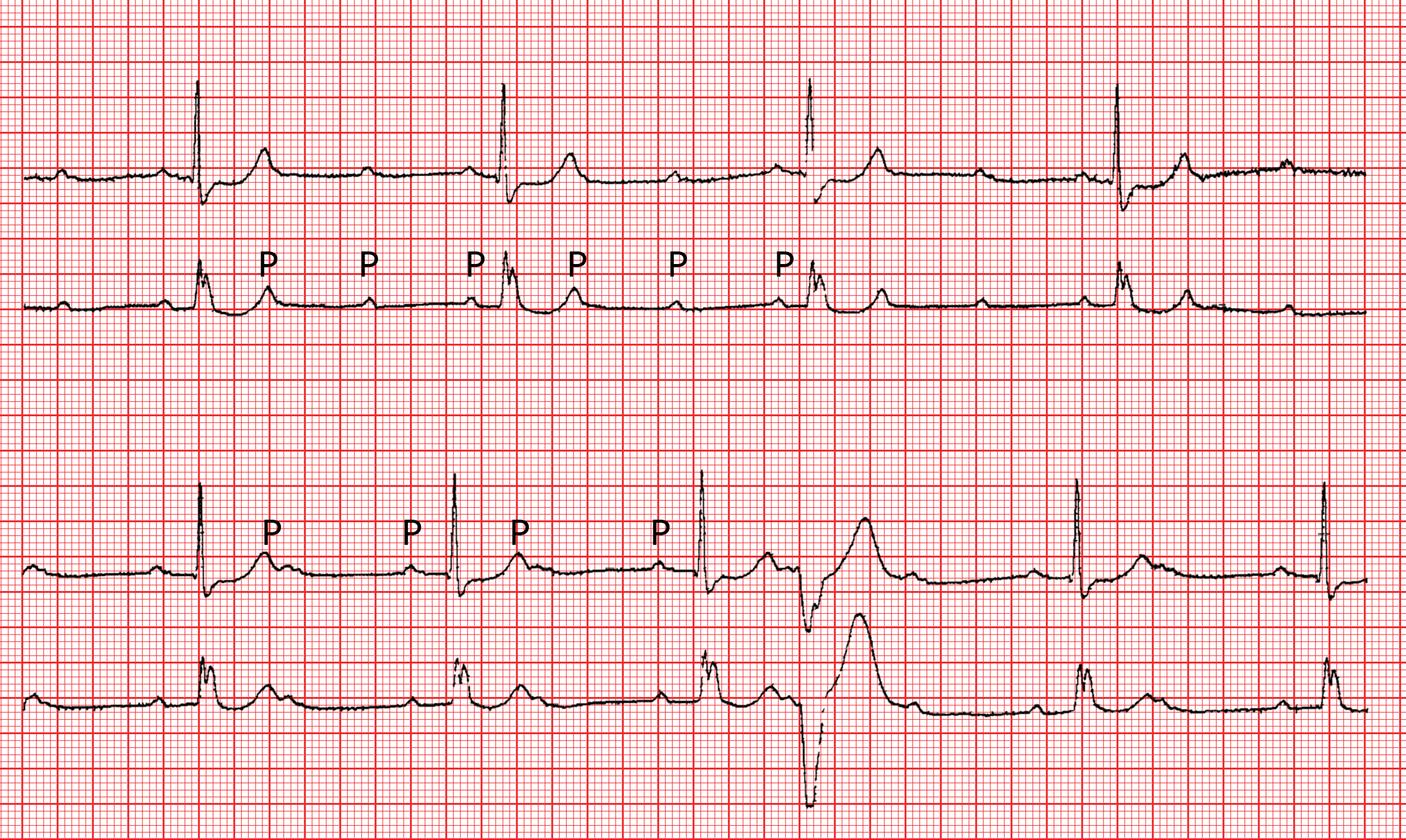 AVBlockierungen ECG