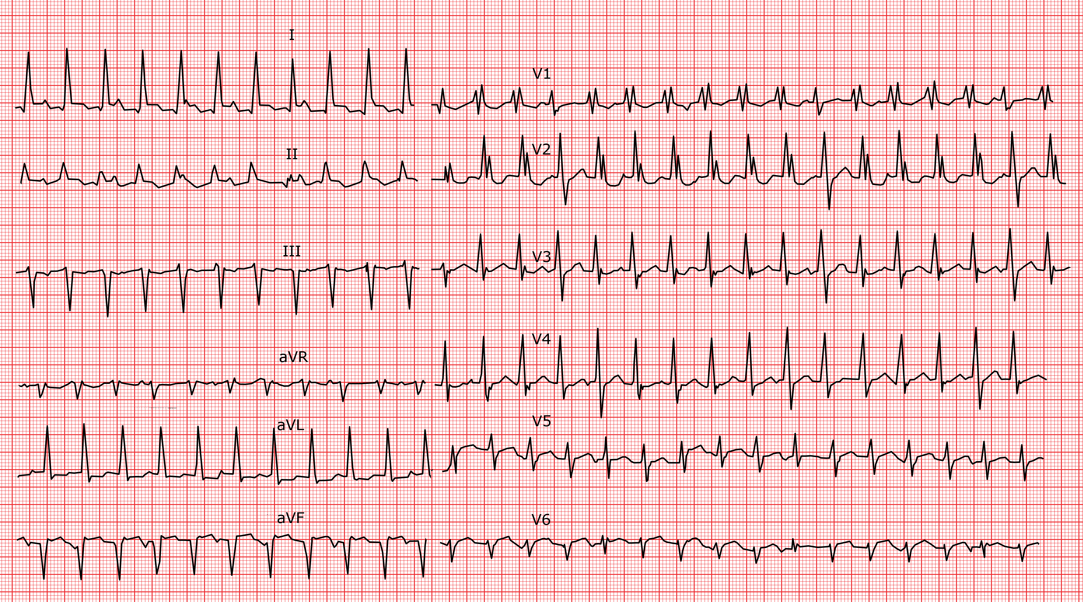 Die ventrikulären Tachykardien (KT) ECG
