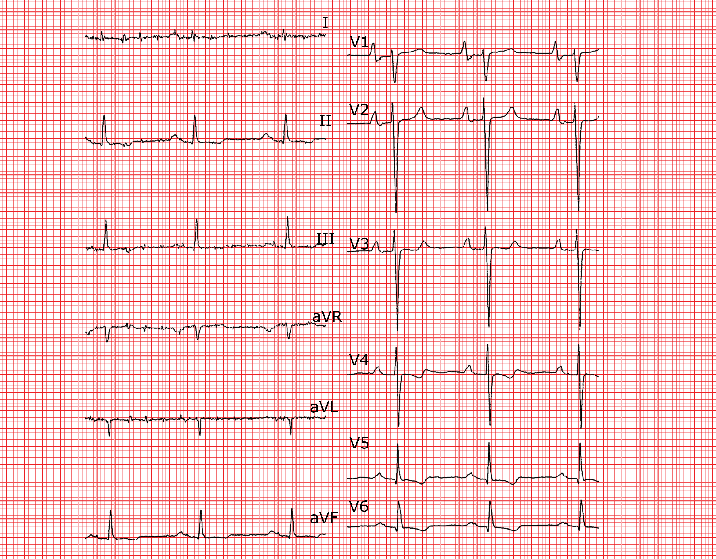 Hypertrophie biauriculaire ECG