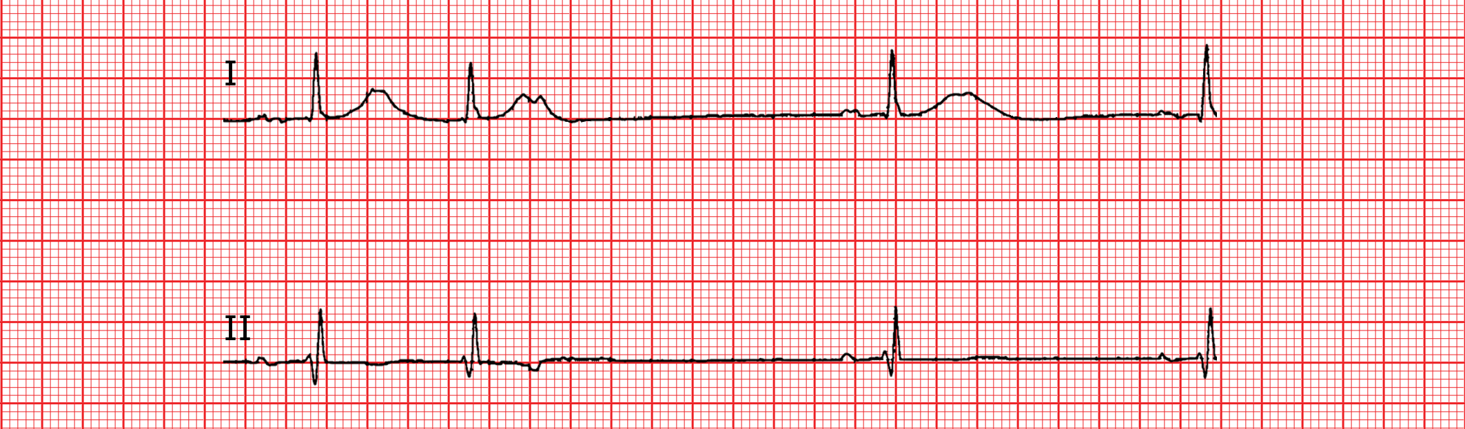Les extrasystoles ECG