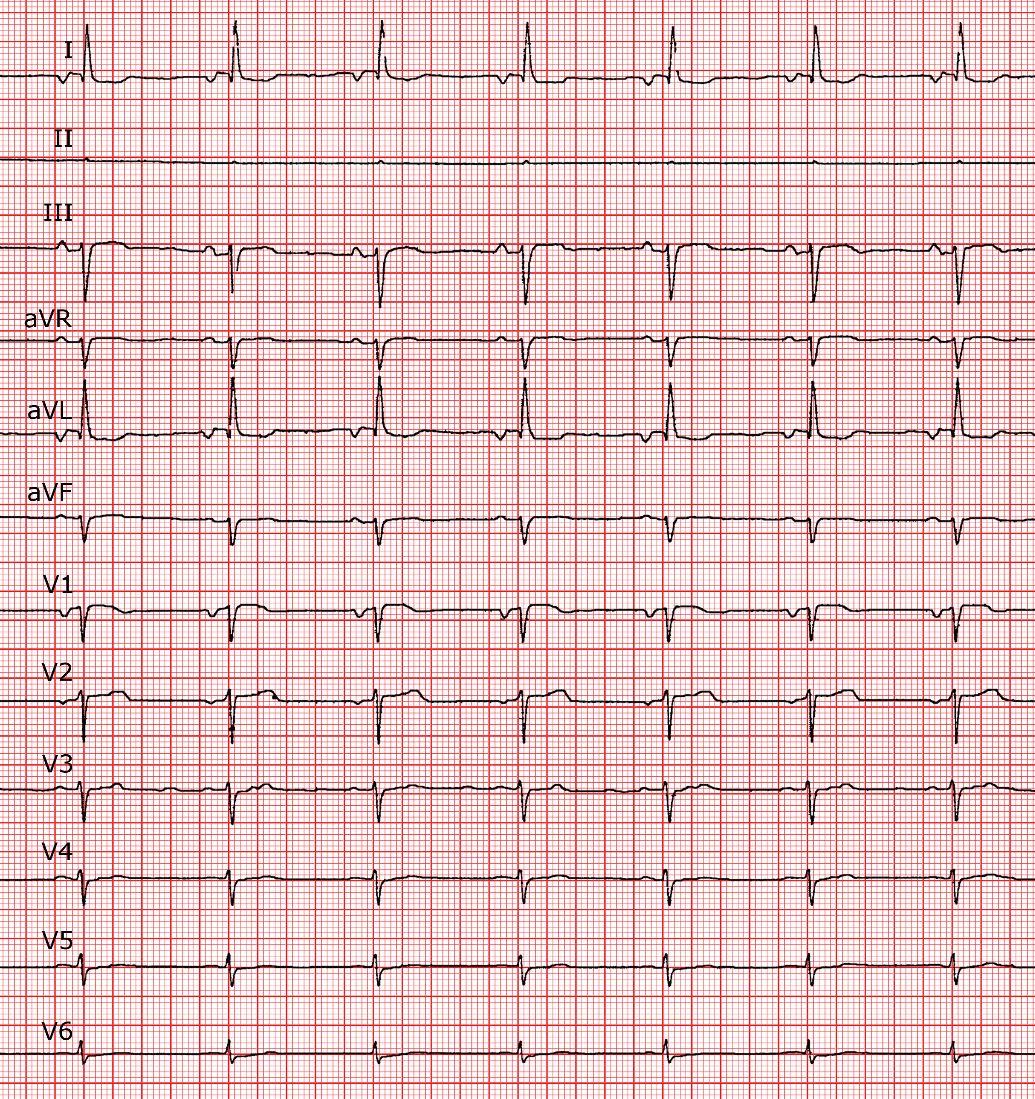 Kardiale Erregung ECG