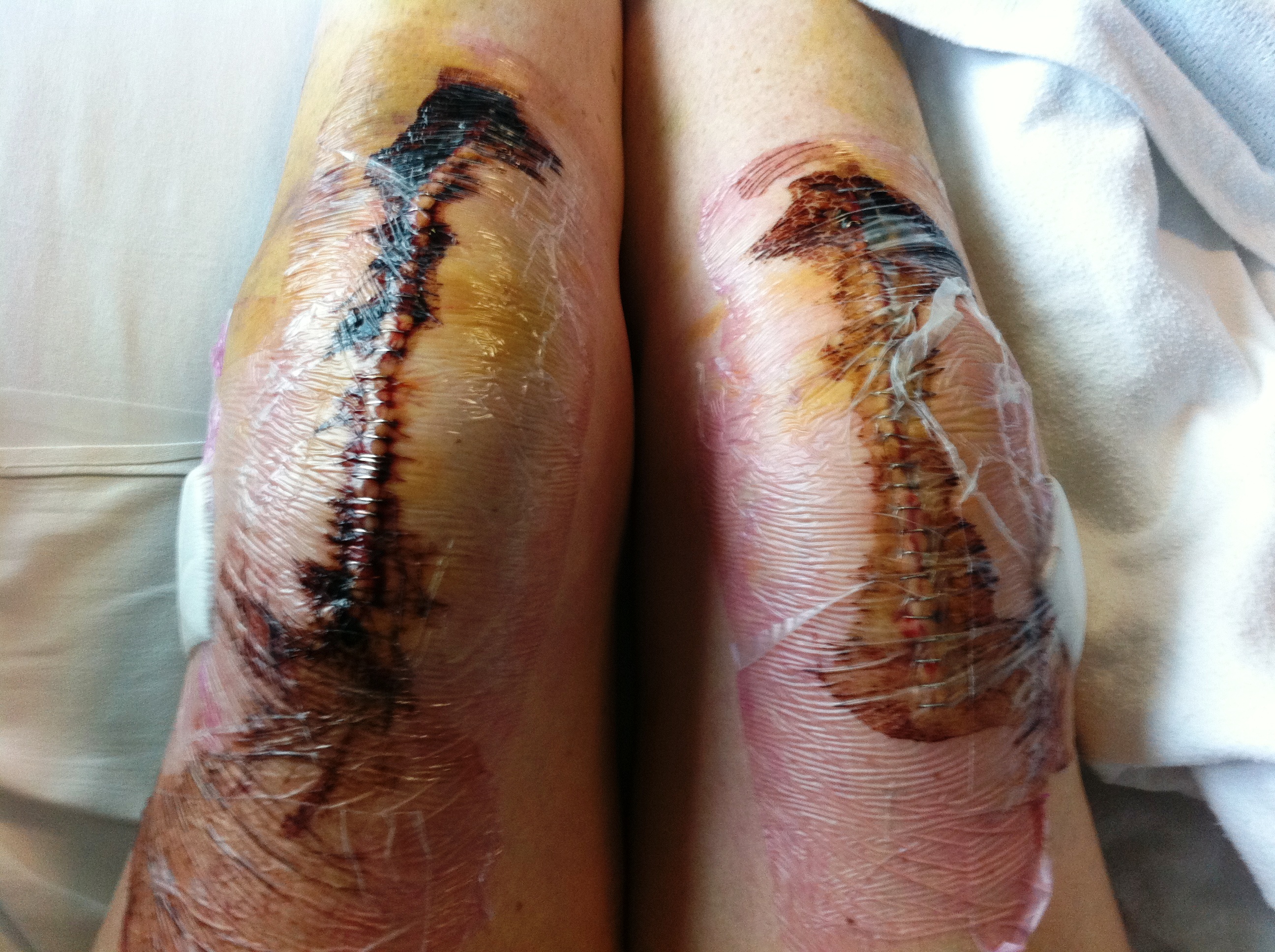 Diary Of A Bilateral Total Knee Replacement; Part 1 | Book Slattern 1936_x_2592_jpg