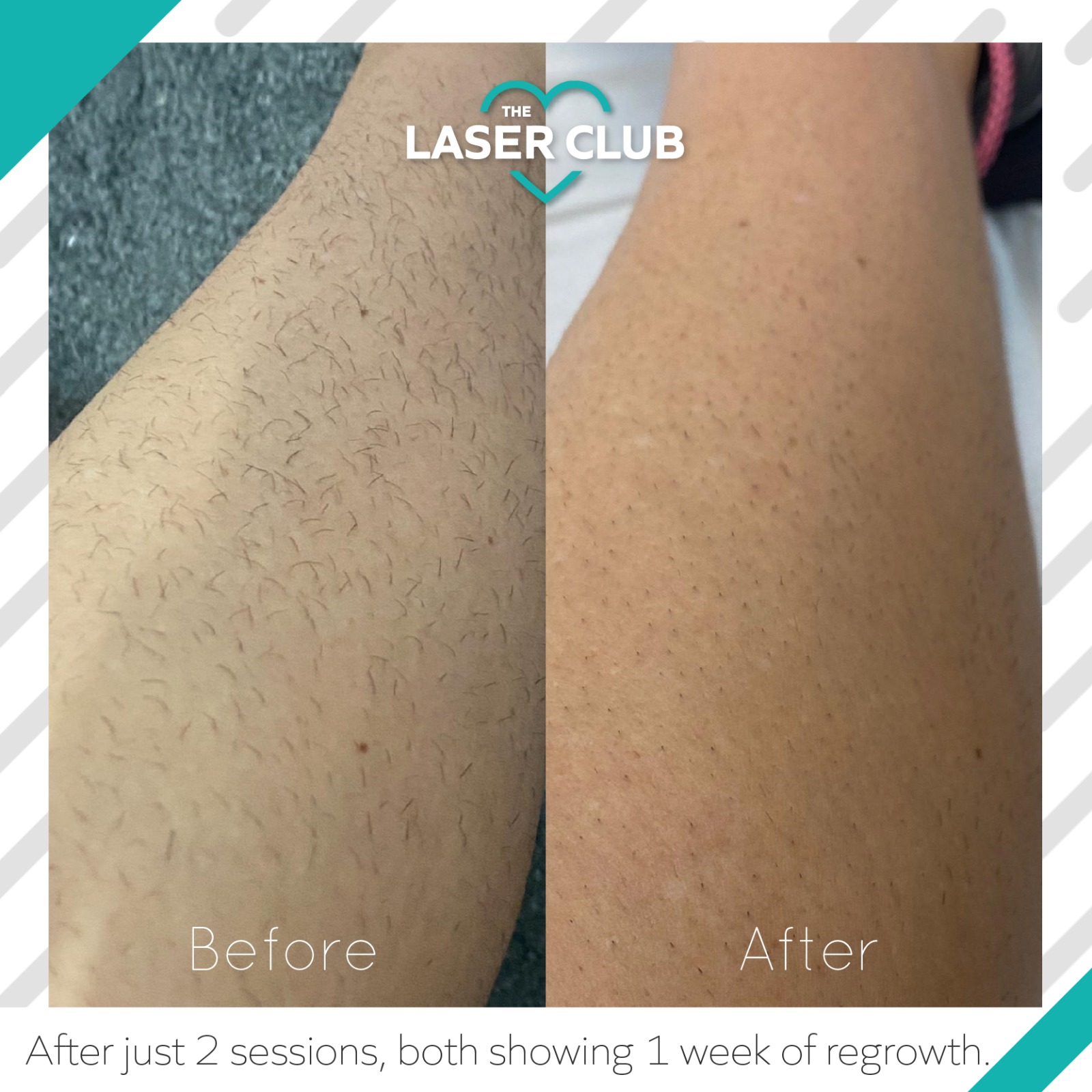 Laser Hair Removal Boombae