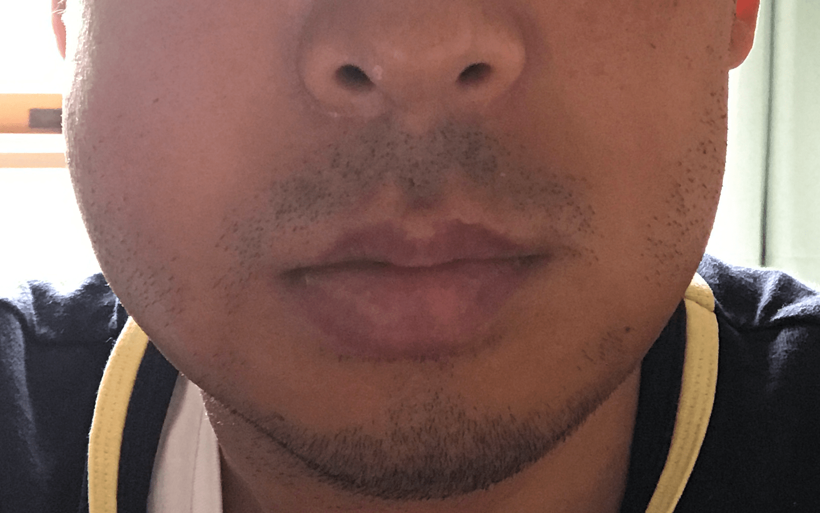 【抜歯後が辛い】親知らず抜歯とかいう、口内土木工事の拷問体験〜回復記録【下2本同時】 株式会社ボーダー