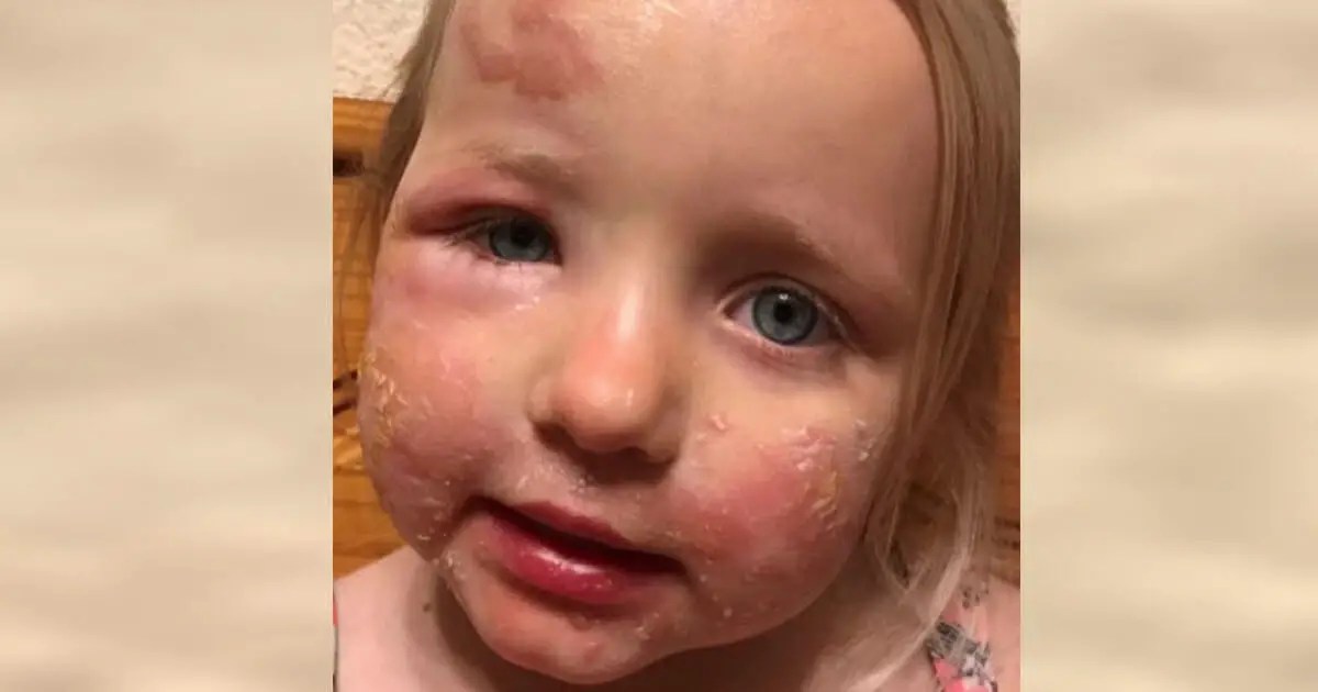 Margarita burns Mom left in shock after 3yearold gets severe skin