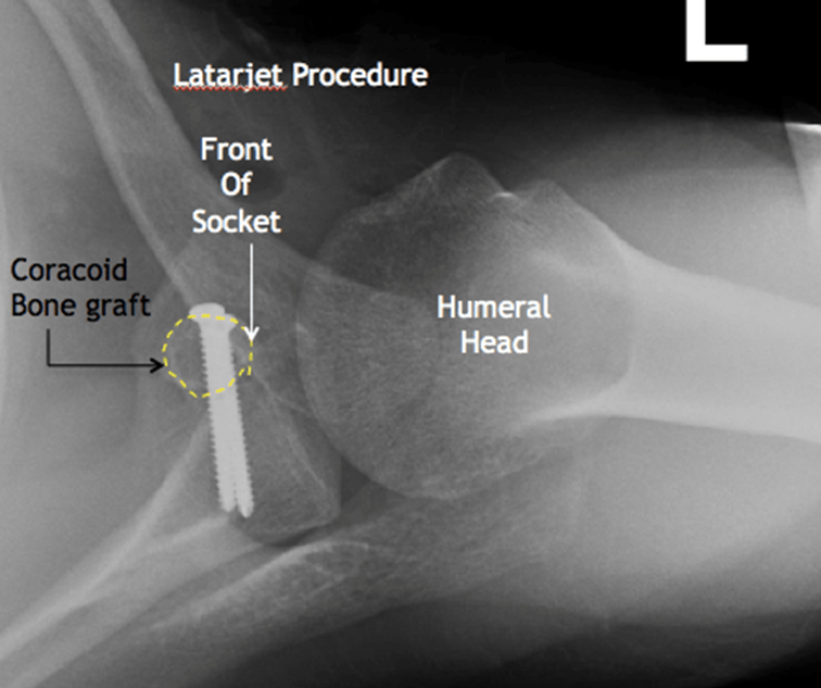 Treatment of Recurrent Anterior Shoulder Instability Boston Shoulder