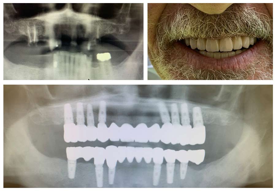 Dental Implants Boulder Dental Center
