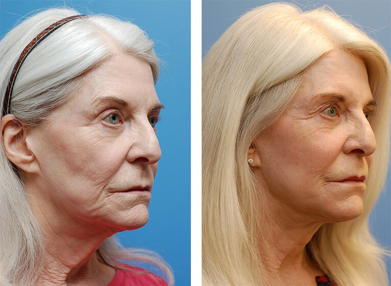 Facelift Patient 21 Boulder CO Boulder Plastic Surgery