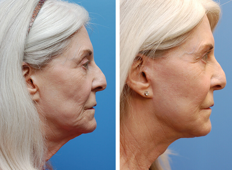 beforeafterside Boulder Plastic Surgery