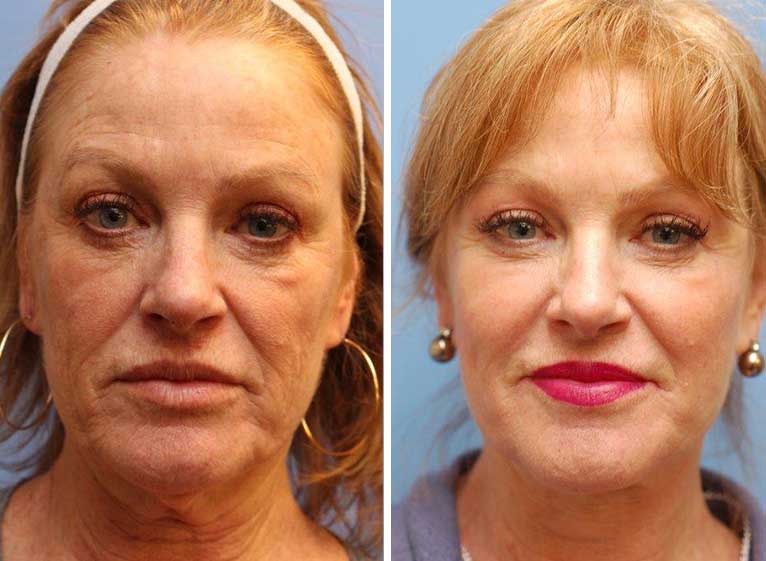 Facelift Patient 29 Boulder CO Boulder Plastic Surgery