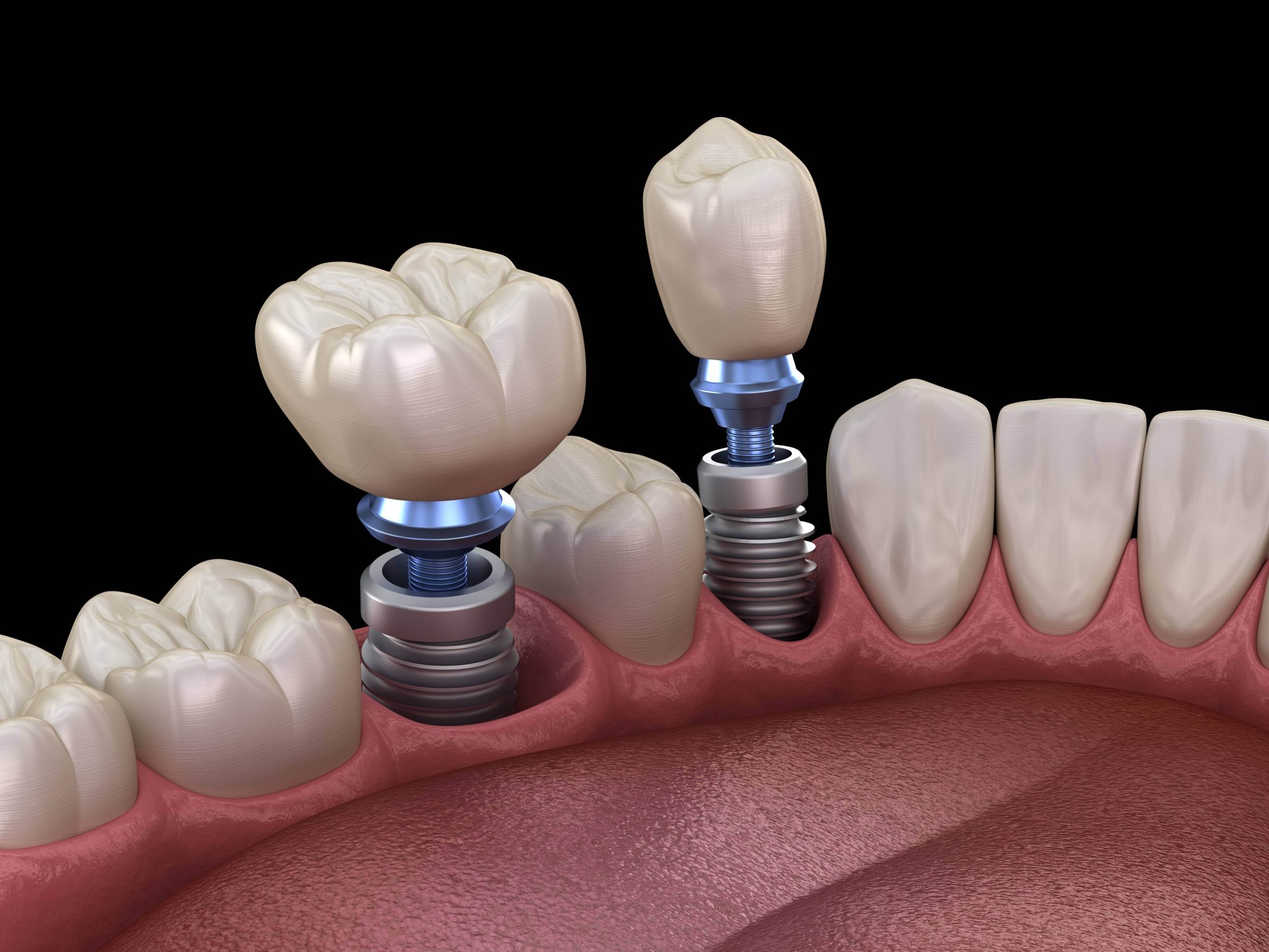 How Often Do Dental Implants Need to be Replaced? Boulder Premier