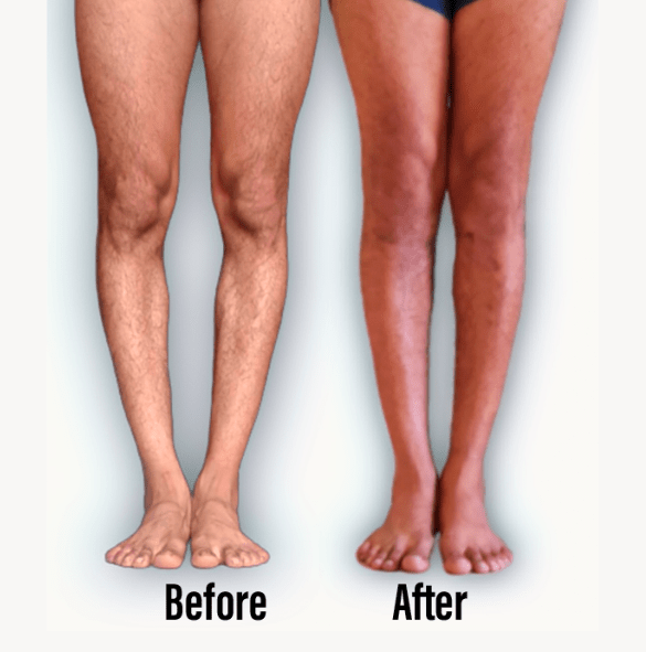 How Much Does It Cost For Bow Leg Surgery at Jaime Solorio blog