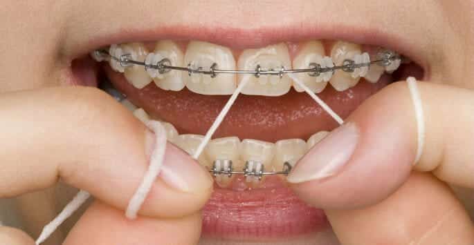 Is it Possible to Remove Stains from Braces? Brodie