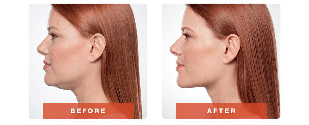 No double Chin is the Same in Seattle Vascular Surgeon Near Me