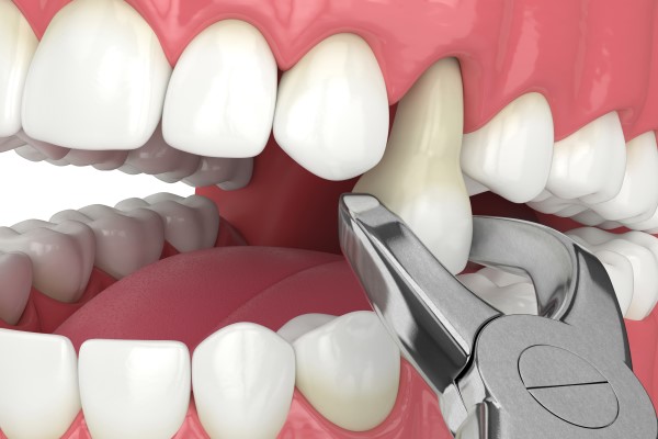 What Occurs During a Tooth Extraction Procedure? Town Square