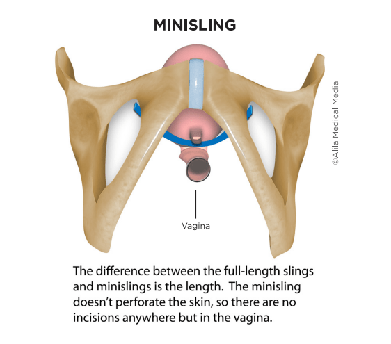 Midurethral Sling for Stress Urinary Incontinence Brazosport Womens Health