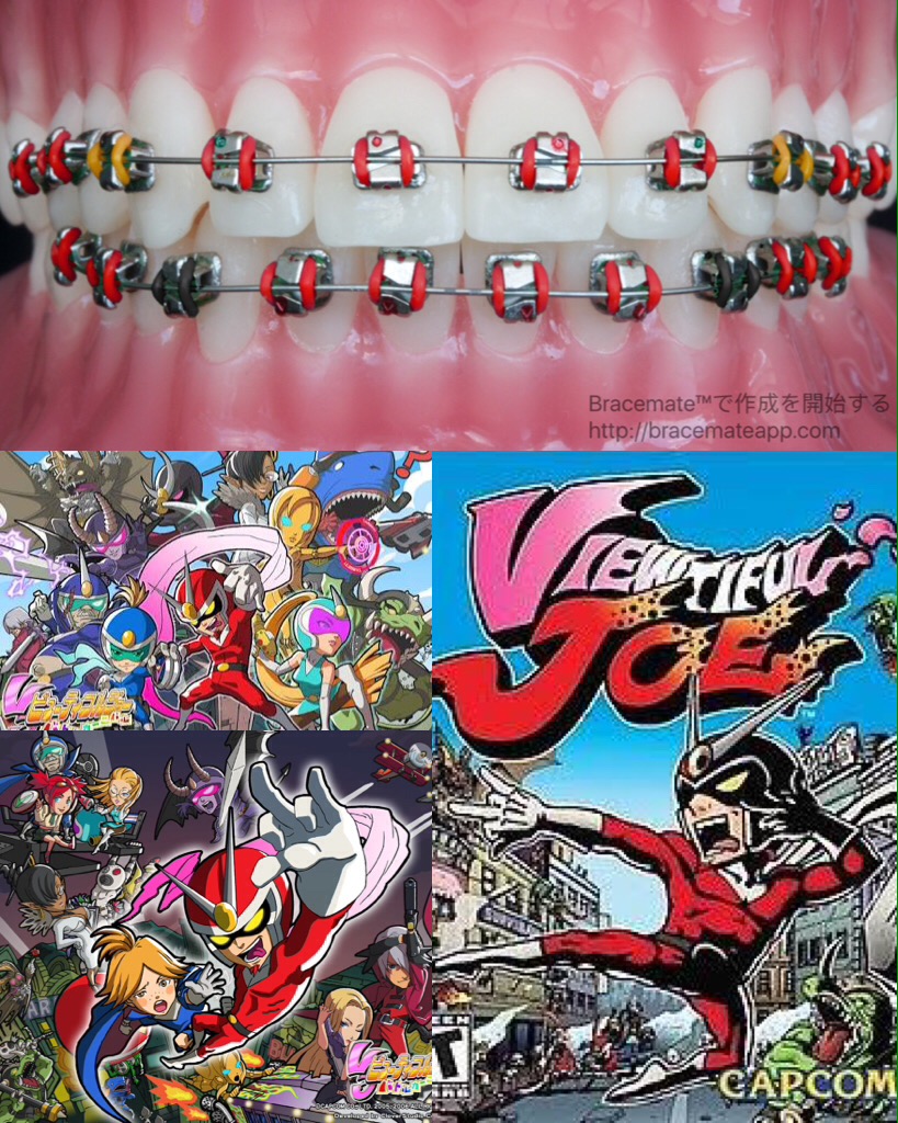 Viewtiful joe braces colors EndoPrepApp