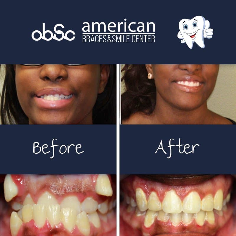 Crossbite Braces Before After