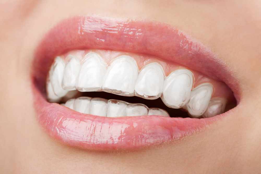 Invisalign & Invisalign Teen Owen Orthodontics