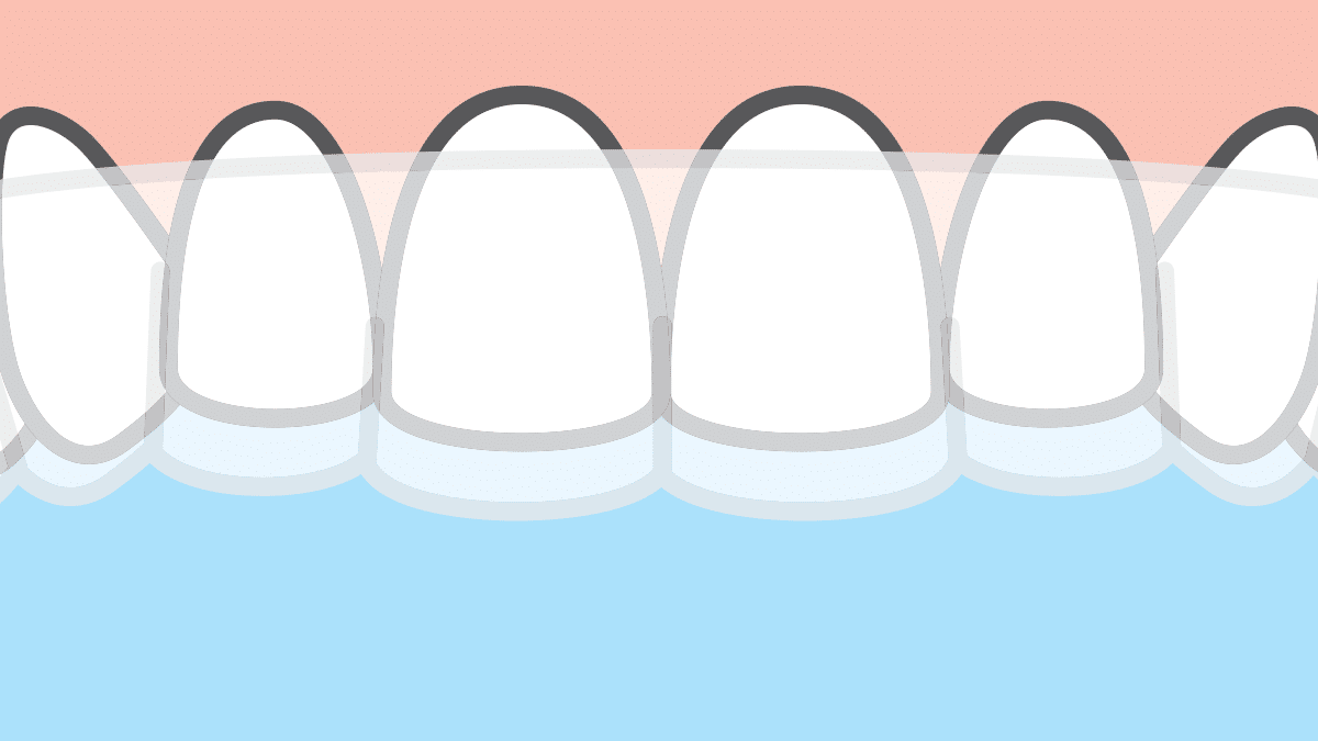 How to Properly Insert Invisalign Aligners bracesetters