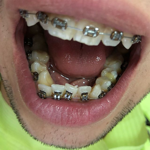 10 Key Details about Gold Braces Braces Explained