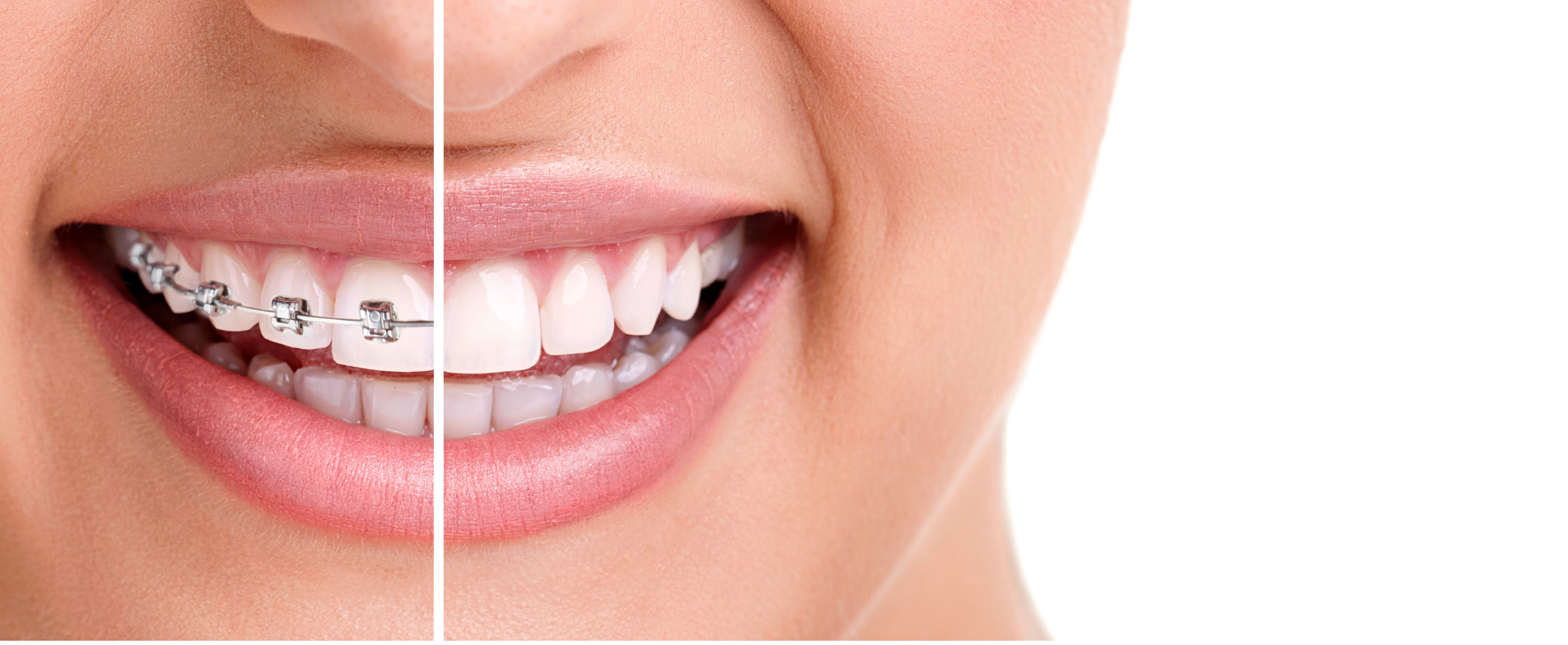 Invisible Braces Ottawa Incognito Braces Ottawa Braces in Ottawa