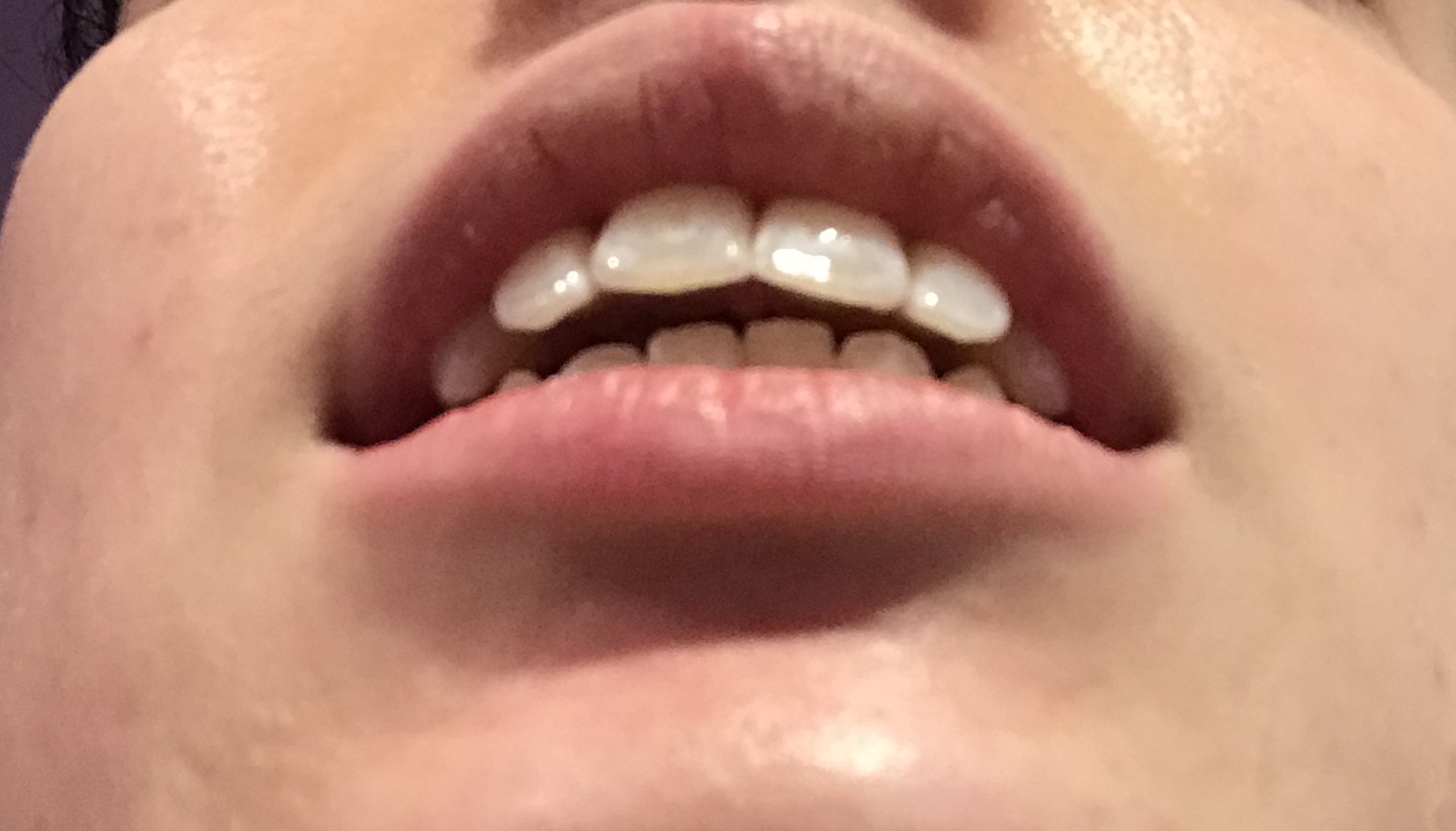 What‌ ‌to‌ ‌do‌ ‌if‌ ‌your‌ ‌retainer‌ ‌doesn’t‌ ‌fit‌ ‌anymore‌? The.