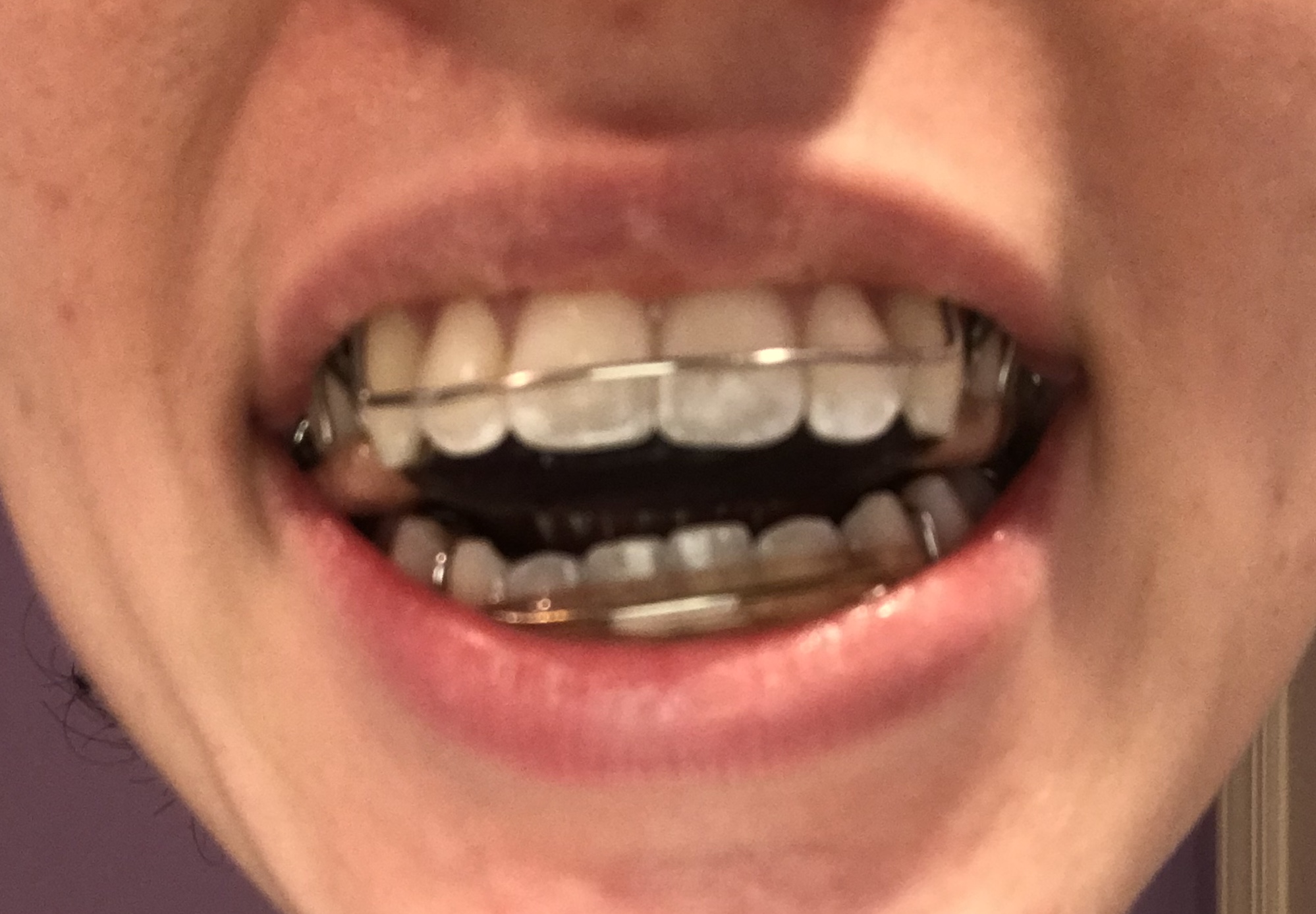 9+ what to do if your retainer doesn t fit most standard