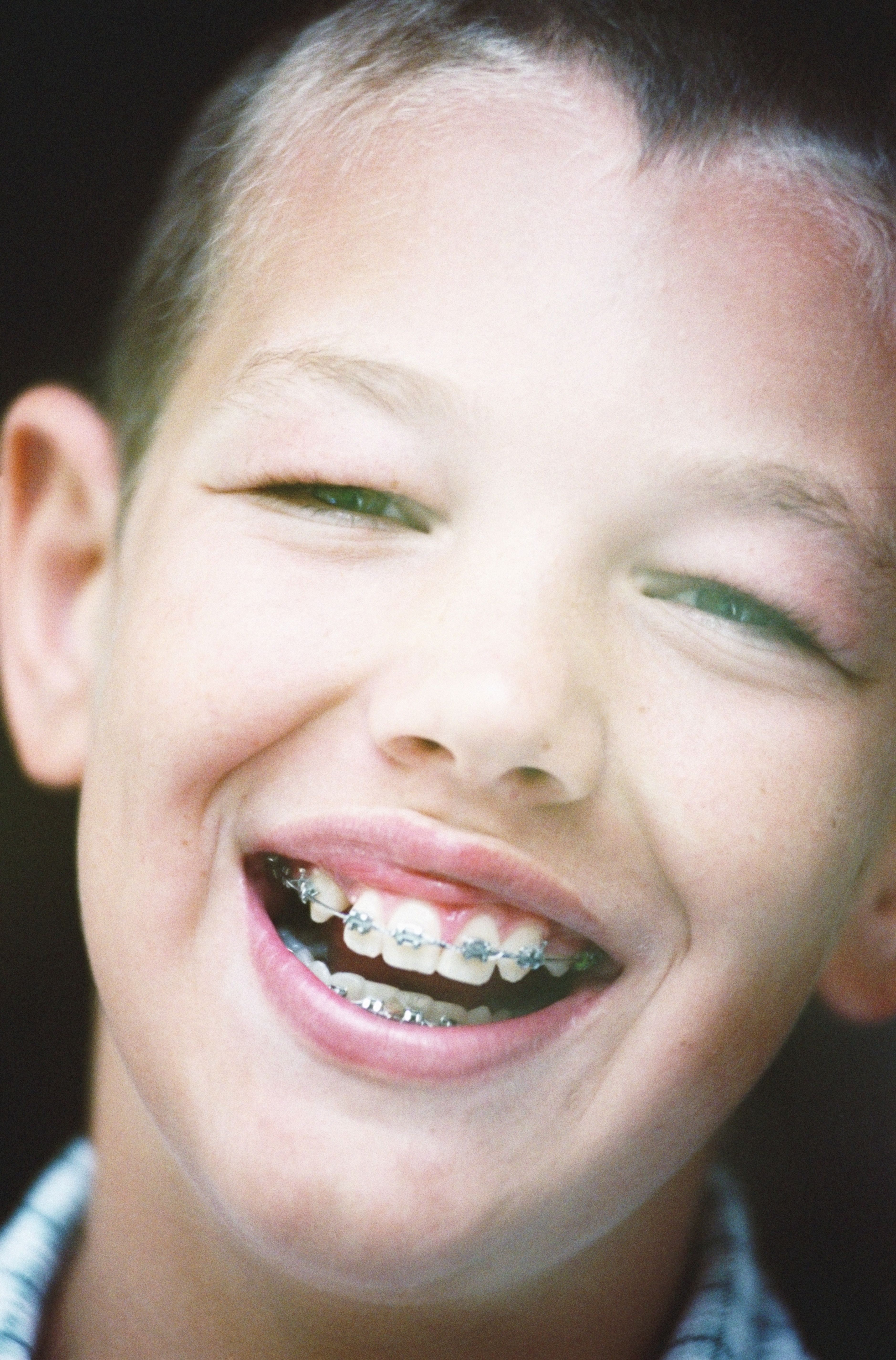 How Much are Braces for Kids? Braces Or