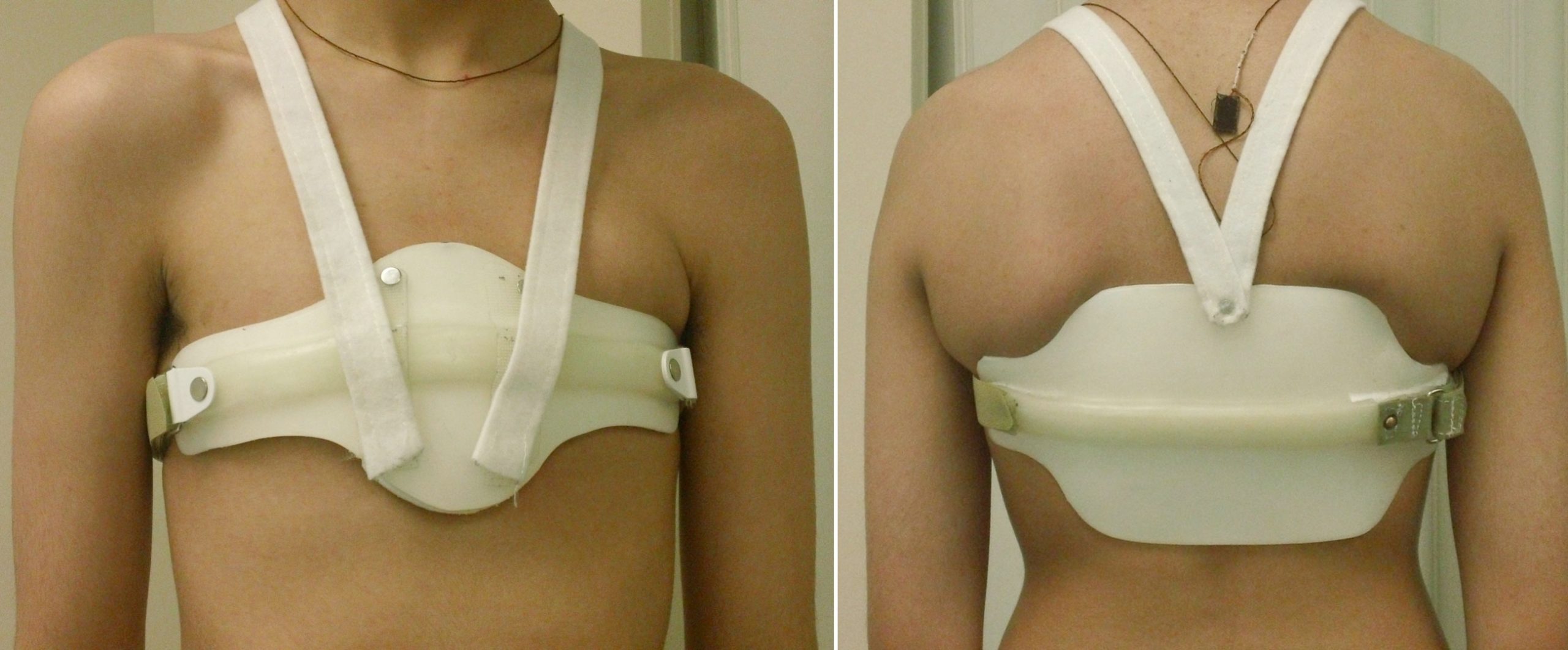 UCSF Pectus carinatum orthosis A pilot study Braceworks Custom Orthotics