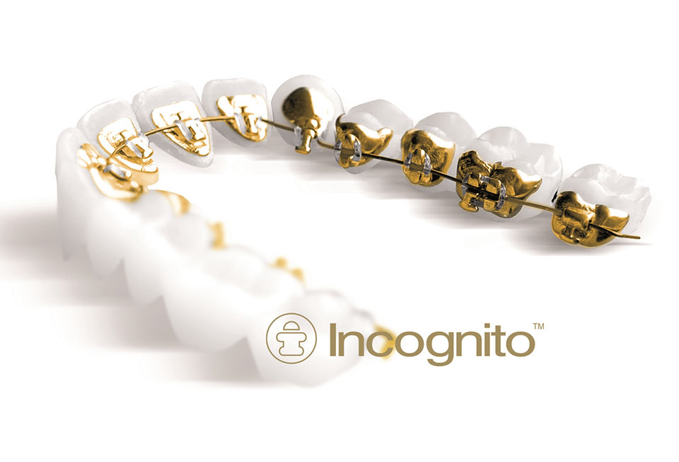 Lingual Braces Dr. Blaine Langberg Orthodontics Ridgefield, CT