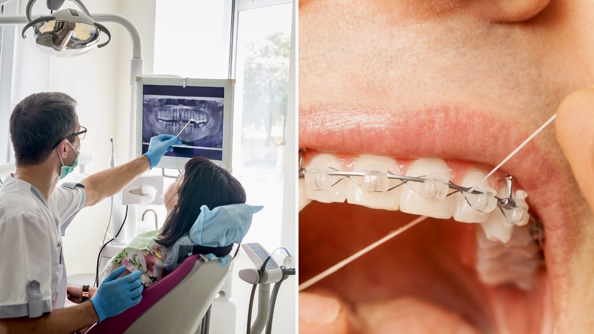 Brackets Cerámicos ¿Son la mejor opción en 2020?