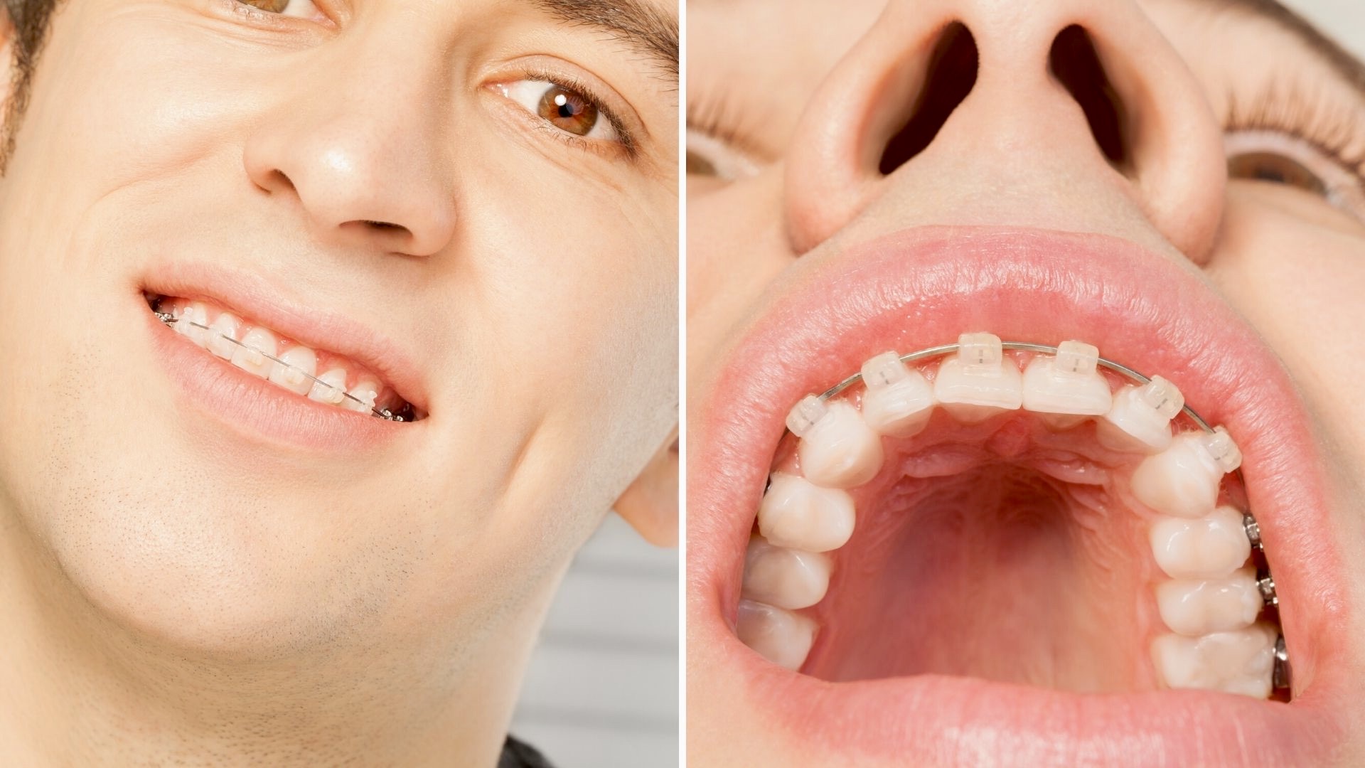 Todo Sobre los Brackets de Zafiro. La Mejor Guía de 2022