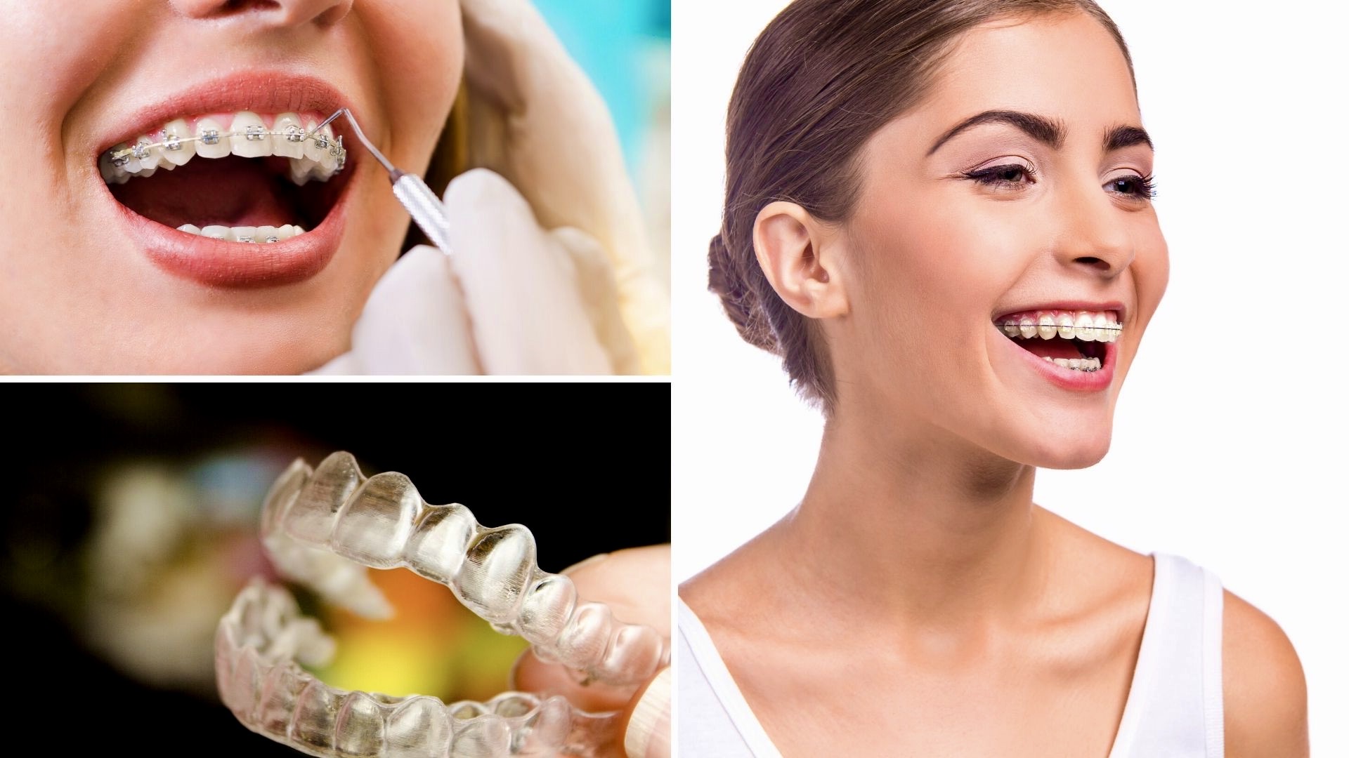 Brackets Transparentes ¿Cuál es tu mejor opción?