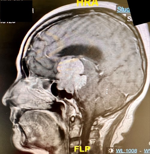What is a Skull Base Tumour Types, Causes & Symptoms