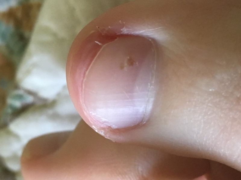 Ingrown Toenails Many Need Treatment from A Medical Professional