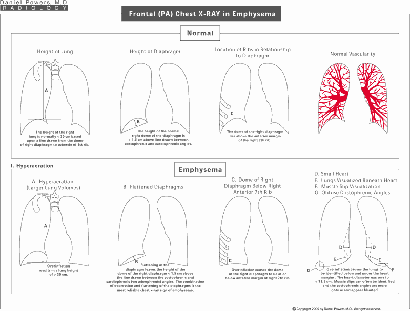 Frontal (PA) Chest XRAY in Emphysema