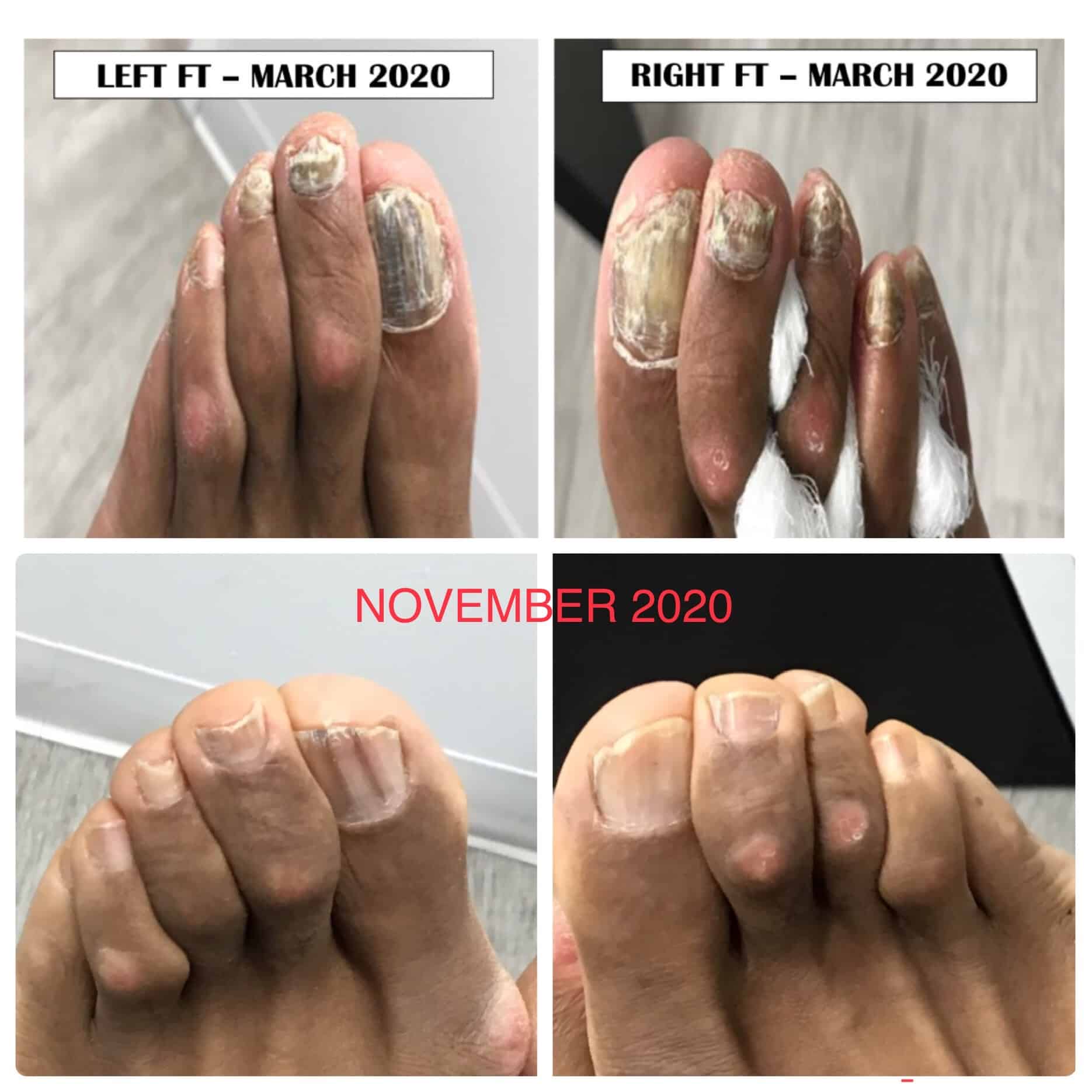 Toenail Fungus Bregman FootAnkle & Nerve Center