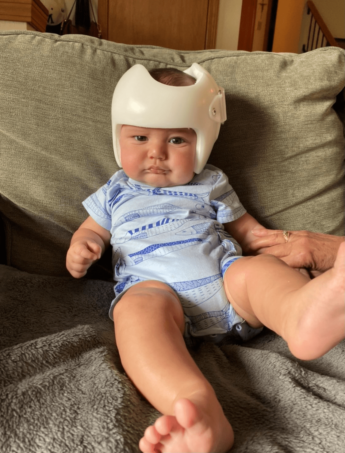 baby helmet therapy Don't Blink